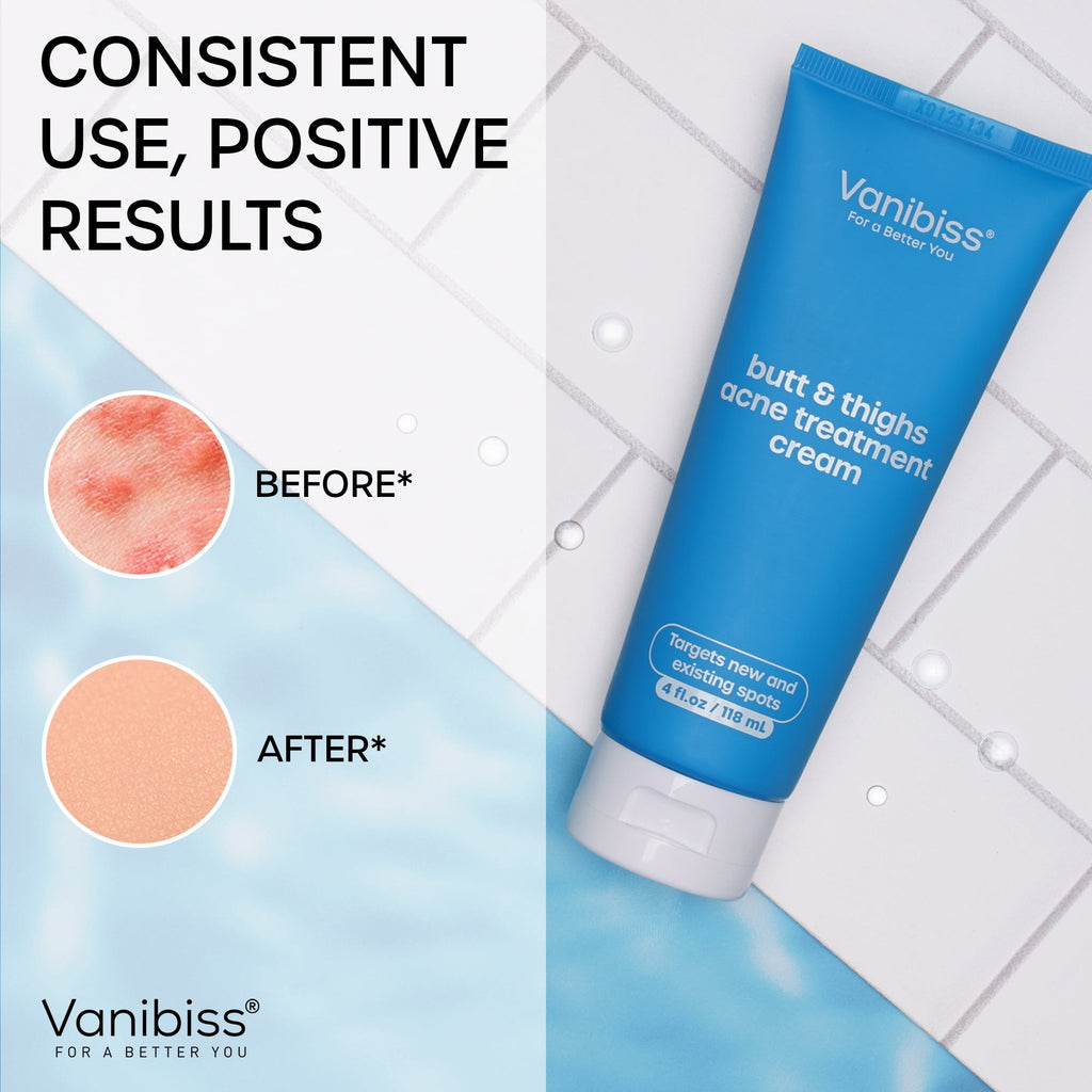 Vanibiss Butt and Thighs Acne Treatment Cream with 2% Salicylic Acid, Exfoliates & Repairs Acne-Prone Skin, 4oz