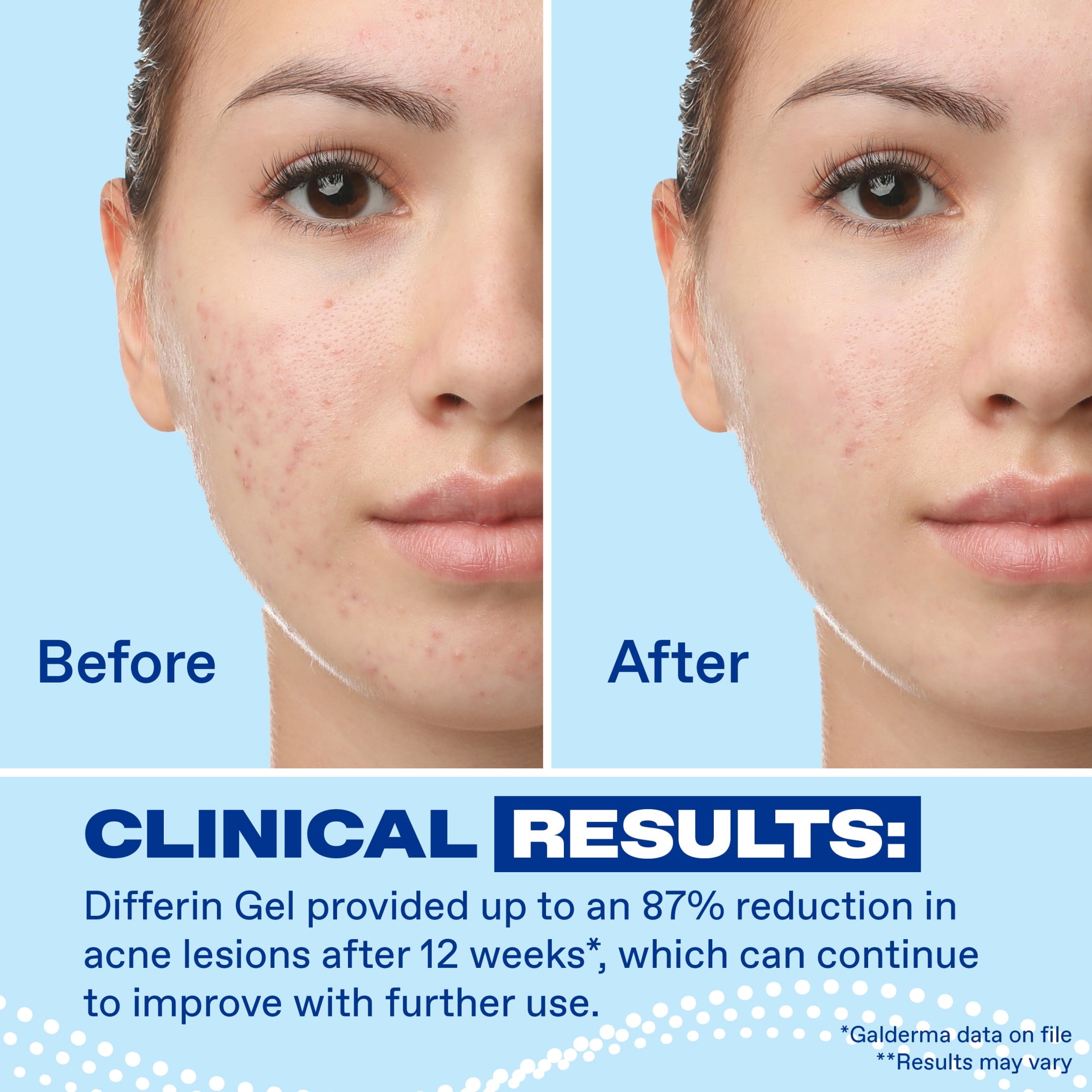 Differin Prescription-Strength Retinoid Acne Treatment Gel for Face with 0.1% Adapalene, Clears & Prevents Acne, Fragrance-Free, 15g Tube