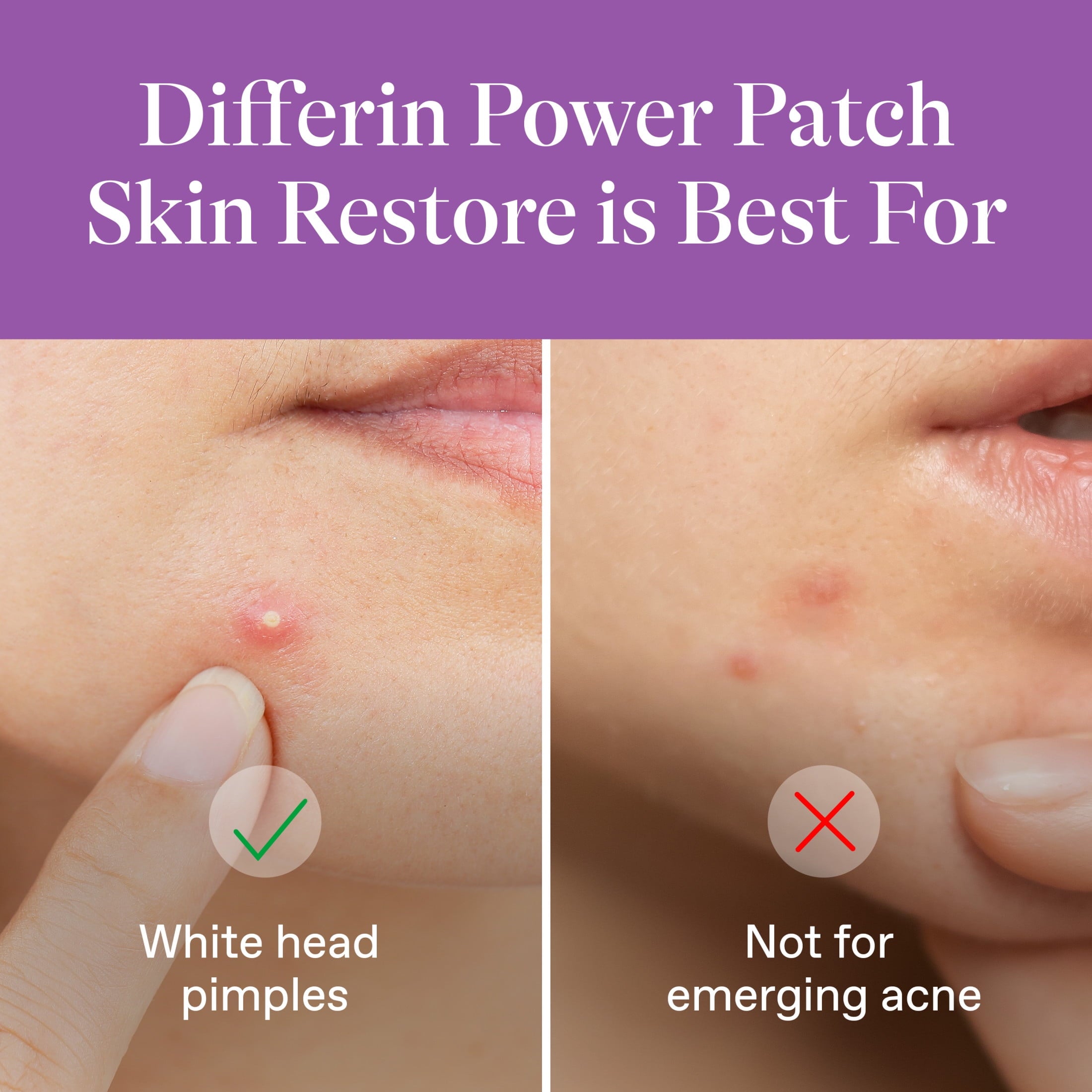 Differin Power Patches for White Head Pimples, Hydrocolloid Acne Patches, Zinc Hyaluronate and Niacinamide, 23 ct